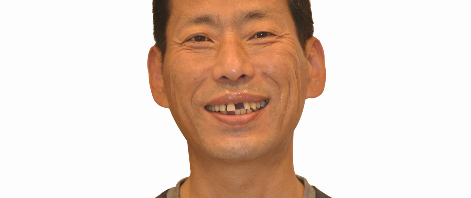 전후사진 후